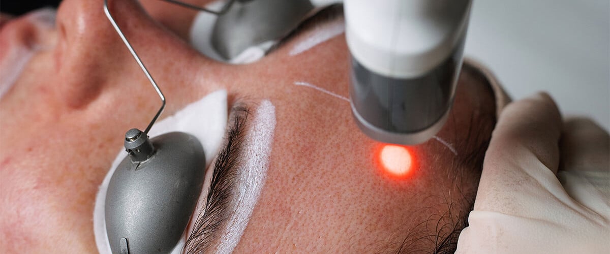 Laser Facials 2